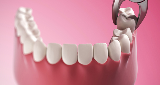 Бесплатное удаление зуба при одномоментной имплантации