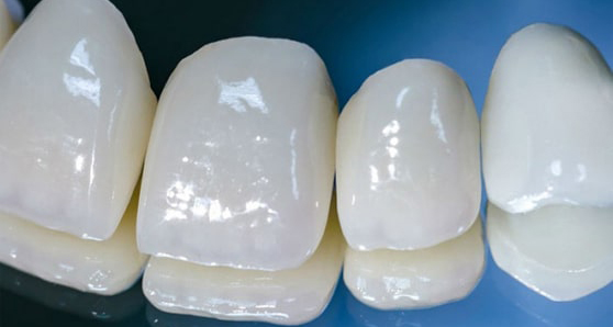 Коронки и зубы из диоксида циркония с применением вкладки по цене 18000 руб.
