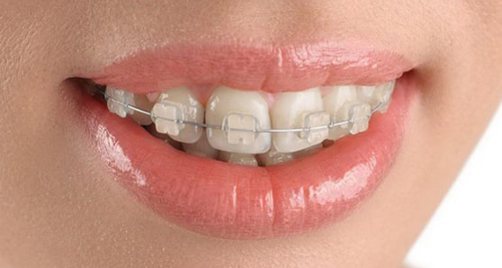 Ортодонтическое лечение «Под ключ» безлигатурной брекет-системой (аналог Damon Q) 150 000 руб