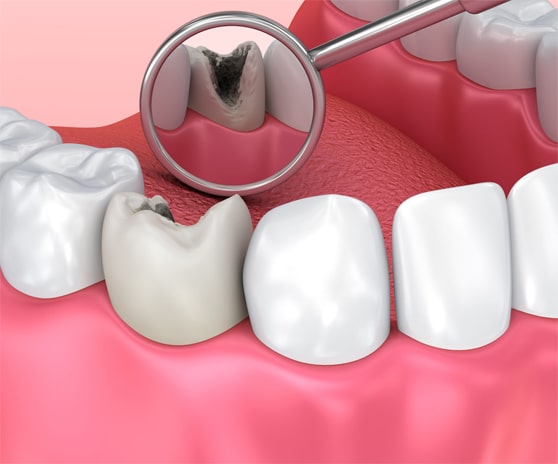 Детское лечение зубов казань