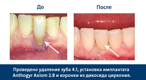 Имплантация зубов по системе Anthogyr (Франция)