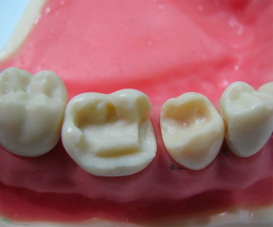 Лечение передних зубов казань